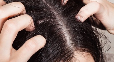  Пърхот – причини и лечение с натурални средства