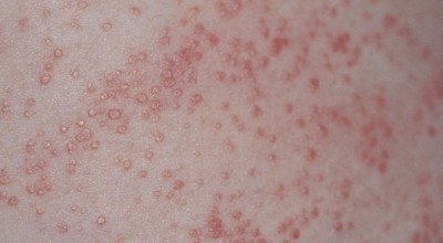 За малките пъпчици при бебетата – потница – 1 част