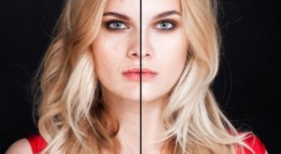 Лекува ли се розацея?