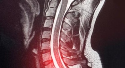 Какво трябва да знаем за костните шипове? Какво трябва да знаем за костните шипове?