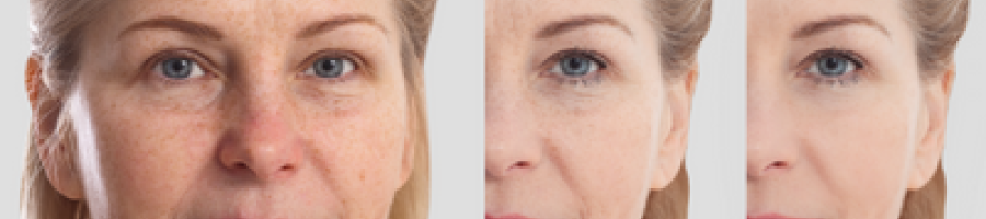 Петна по лицето: как да избегнем пигментацията по кожата?