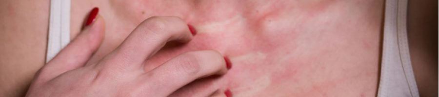 Алергия към слънцето: Какво трябва да знаете, за да не си развалите лятото? 