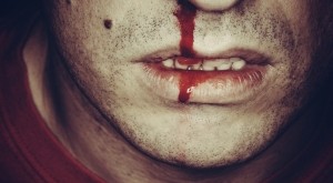 Епистакис (кървене от носа) – съвети за справяне с него Епистакис (кървене от носа) – съвети за справяне с него