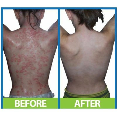 ДермаСпрей Интензив (DermaSpray Intensive) 100 мл | Salcura