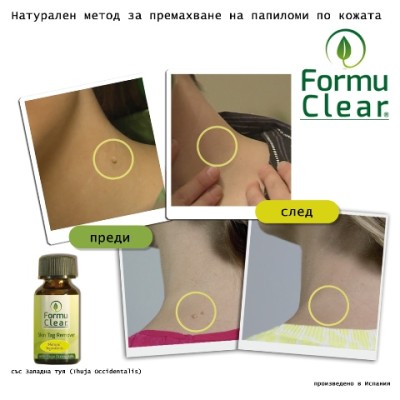 Formu Clear (Формю Клиър) - натурален продукт за премахване на папиломи и брадавици Ако страдате от появата на брадавици и папиломи и искате да се отървете от тях без да се налага да се подлагате на операции Formu Clear (Формю Клиър) - натурален продукт з