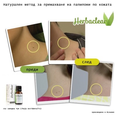 Herbaclear за премахване на брадавици Изцяло натурален и безопасен продукт Без болка и дразнене Какво представлява Herbaclear? Herbaclear е един уникален по рода си продукт, който е предназначен за прем Herbaclear за премахване на брадавици Изцяло натурал