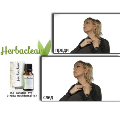 Herbaclear за премахване на брадавици Изцяло натурален и безопасен продукт Без болка и дразнене Какво представлява Herbaclear? Herbaclear е един уникален по рода си продукт, който е предназначен за прем Herbaclear за премахване на брадавици Изцяло натурал