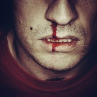 Епистакис (кървене от носа) – съвети за справяне с него
