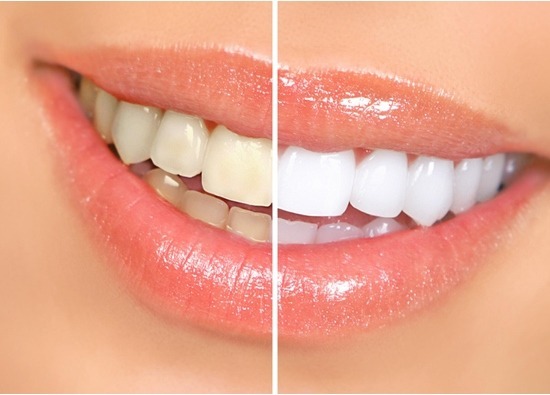 Wonder white за избелване на зъби и красива усмивка на добра цена. 