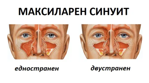 Причина за вода от носа може да е микселарен синуит