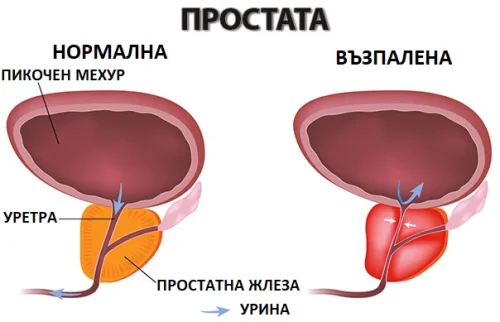 Медикаментозното лечение на възпаление или аденом на простатата може да продължи дълго