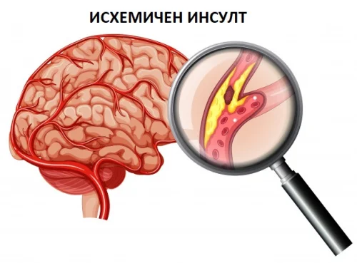 Видовете инсулт са исхемичен и хеморагичен