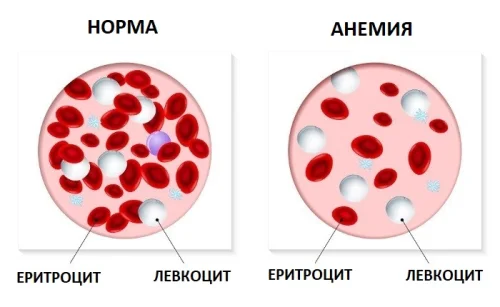 При анемия хемоглобинът, тоест количеството на желязото в кръвта е понижено