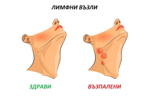 При възпаление лимфните възли се увеличават по размер