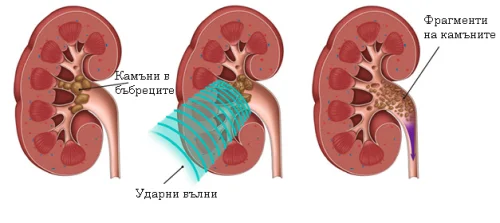 Методи за лечение на камъни в бъбреците - ултразвукови ударни вълни за разбиване на бъбречни камъни.