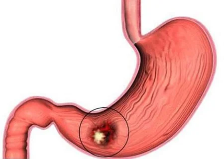 Algem Anti Reflux от Algem Natura помага срещу язва и гастрит.