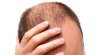 Minoxidil 5% Foligain N5 срещу косопад и оплешивяване за мъже на изгодна цена е за локално приложение и се използва за стимулиране растежа на косата при хора, които оплешивяват.