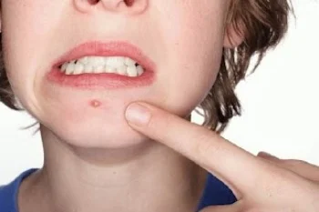 Диметилсулфоксид от Biovea има mnogo добро въздействие при други екземи, акне, както и про гнойни рани и артрит