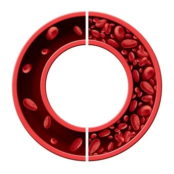 High Absorption Iron With Ferrochel помага при анемия, атрофичен гастрит, железен дефицит