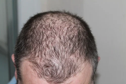 Alpecine Caffeine Shampoo C1 250 мл на ниска цена от Dr. Wolff против косопад.