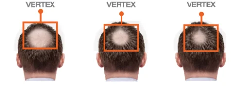 Minoxidil 5% Hair Regrowth Treatment For Men 3x60 мл на топ цена от Foligain е изключително ефективно средство за справяне с косопад.