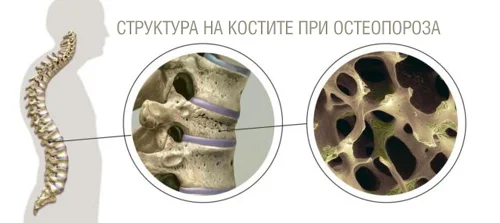 Добавка за здрави кости на таблетки с топ цена възстановява здравата костна структура