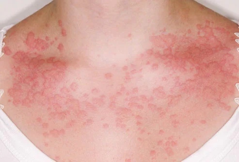Respir-ALL Allergy на страхотна цена действа при простуда и грип, потиска кожни възпаления и алергични състояния.