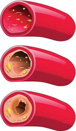 Acerola - Vitamin C от Sanct Bernhard предпазва от атеросклероза и подобрява сърдечното здраве
