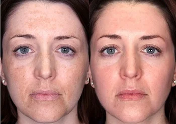Advanced Retinol A Cream на топ цена премахва обривите и пигментните петна и детоксикира кожата