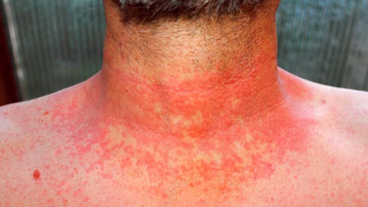 Автоимунните заболявания могат да увредят кожата