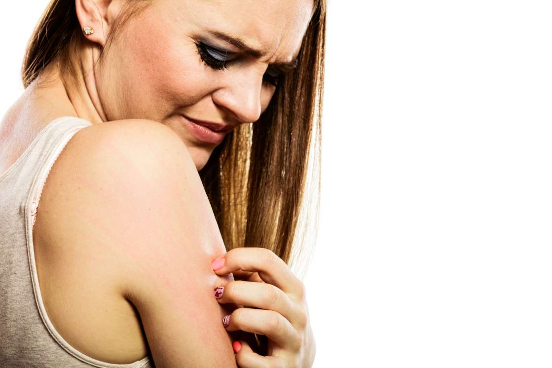 Симптомите на екзема са сърбеж, суха и раздразнена кожа, обрив, цепене и лющене на кожата.