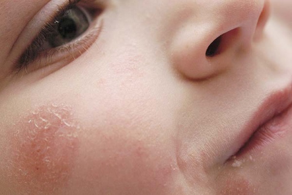 При децата може да се появи себореен дерматит, който засяга кожата на главата, лицето, веждите, зад ушите.