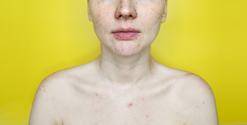 Куперозата е състояние на кожата, което се характеризира със зачервяване на кожата и червени петна по лицето.