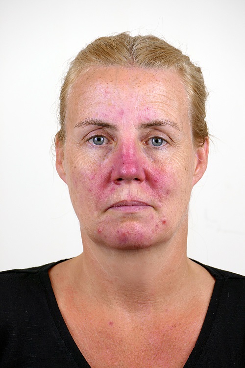 Зачервяването на кожата може да е симптом на розацея или купероза.