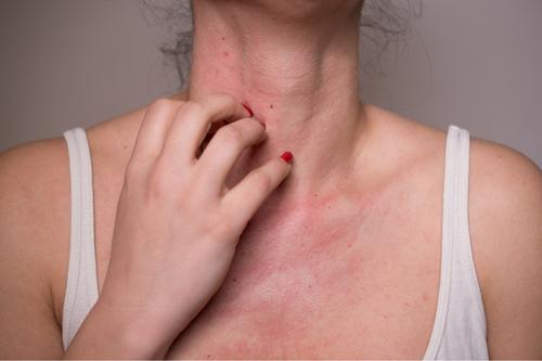 Обрив по кожата след излагане на слънце - слънчева алергия.