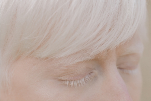 Какво е да си албинос и в каква социална среда живеят хората с албинизъм?