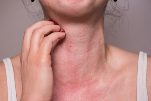 Алергията към слънчеви бани се разбира като фотодерматит или фотодерматоза, тъй като самият алергичен компонент не присъства в слънчевите лъчи.