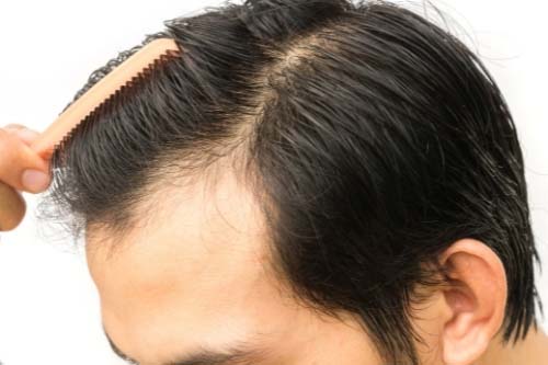 Миноксидил 5% за Мъже Слабоалкохолна формула на отлична цена от Foligain стимулира растежа на косата