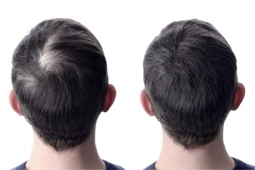 Миноксидил 5% за Мъже Слабоалкохолна формула 3x60 мл на супер цена възстановява растежа на косата от Foligain възстановява растежа на косата