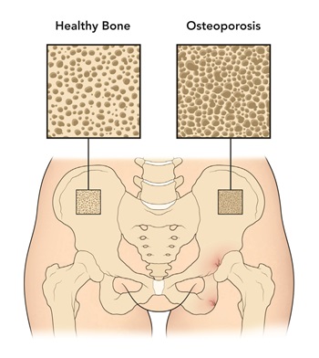 Витамин Д3 на гел-капсули на супер цена предпазва от разрушаване костите, укрепва тяхната здравина и възпрепятства развитието на остеопороза.